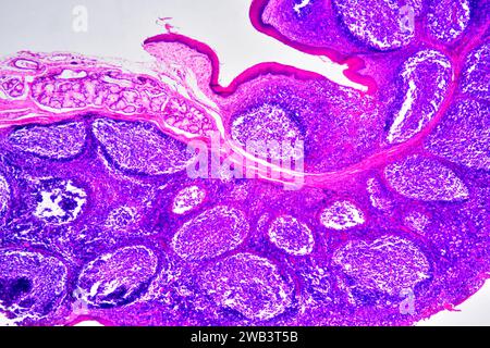 Human palatine tonsil section showing circular lymphoid follicles and secretory gland. Light micrograph, haematoxylin eosin stain. X30 when printed 10 Stock Photo