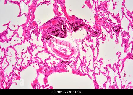 Human lung section showing alveoli, bronchiole and blood vessels. X75 at 10 cm wide. Stock Photo