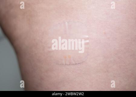 Hormone Replacement Therapy medication: Evorel 50 (estradiol) patch on a thigh Stock Photo