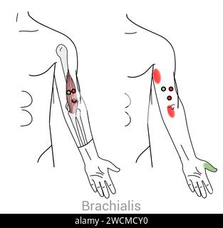 Brachialis: Myofascial trigger points and associated pain locations Stock Photo