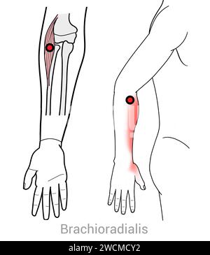 Brachioradialis: Myofascial trigger points and associated pain locations Stock Photo