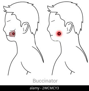 Buccinator: Myofascial trigger points and associated pain locations Stock Photo