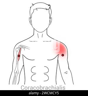 Coracobrachialis: Myofascial trigger points and associated pain locations Stock Photo