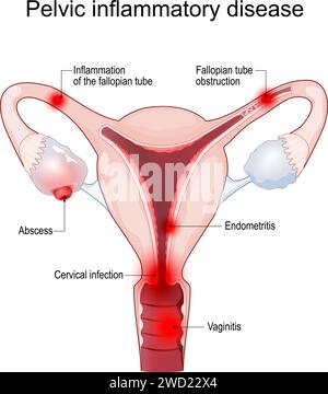 Pelvic inflammatory disease. Cross section of a Uterus with symptoms of Inflammation, fallopian tube obstruction, endometritis, salpingitis, tubo-ovar Stock Vector