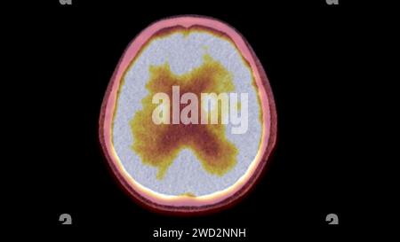 A PET-CT scan image is a diagnostic visualization combining Positron Emission Tomography (PET) and Computed Tomography (CT) for Helps in finding cance Stock Photo