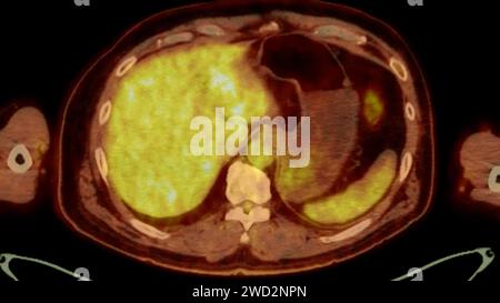 A PET-CT scan image is a diagnostic visualization combining Positron Emission Tomography (PET) and Computed Tomography (CT) for Helps in finding cance Stock Photo