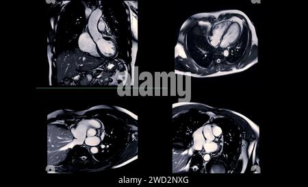 Cardiac MRI images are instrumental in assessing cardiac health, identifying heart abnormalities, and guiding treatment plans. Stock Photo