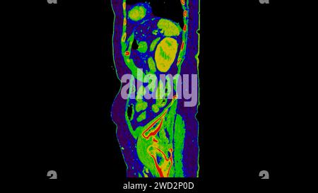 CT scan of Abdomen sagittal view with injection contrast media with ...