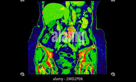 CT scan of  Abdomen  coronal view with injection contrast media with green color mode coronal view for diagnosis  abdominal diseases. Stock Photo