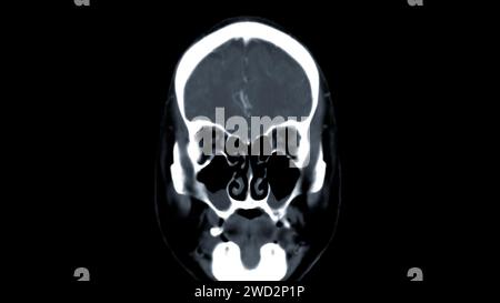 CT scan of the brain Coronal view for diagnosis brain tumor,stroke ...