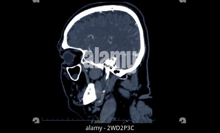 Empty Brain Ct Scan CT scan of the brain sagittal view for diagnosis brain tumor,stroke ...