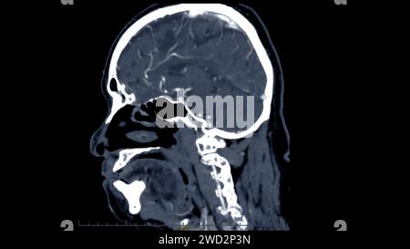 Empty Brain Ct Scan CT scan of the brain sagittal view for diagnosis brain tumor,stroke ...