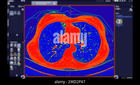 CT scan of Chest Axial view in color mode  for diagnostic Pulmonary embolism (PE) , lung cancer and covid-19. Stock Photo