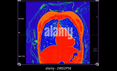 CT scan of Chest coronal view in color mode  for diagnostic Pulmonary embolism (PE) , lung cancer and covid-19. Stock Photo