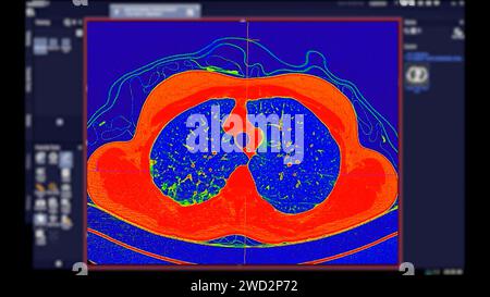 CT scan of Chest Axial view in color mode  for diagnostic Pulmonary embolism (PE) , lung cancer and covid-19. Stock Photo