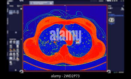 CT scan of Chest Axial view in color mode  for diagnostic Pulmonary embolism (PE) , lung cancer and covid-19. Stock Photo