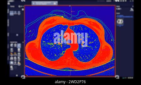 CT scan of Chest Axial view in color mode  for diagnostic Pulmonary embolism (PE) , lung cancer and covid-19. Stock Photo