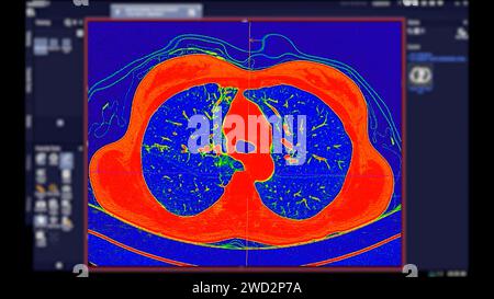 CT scan of Chest Axial view in color mode  for diagnostic Pulmonary embolism (PE) , lung cancer and covid-19. Stock Photo