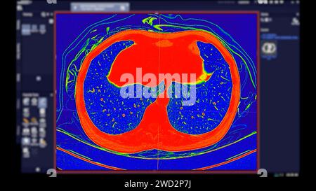 CT scan of Chest Axial view in color mode  for diagnostic Pulmonary embolism (PE) , lung cancer and covid-19. Stock Photo