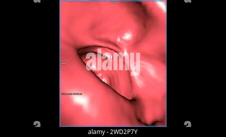 CT colonography , This imaging technique is often employed for colorectal cancer screening, providing detailed images of the colon's interior 3D rende Stock Photo