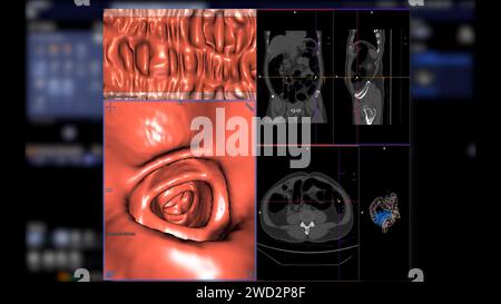 CT colonography , This imaging technique is often employed for colorectal cancer screening, providing detailed images of the colon's interior 3D rende Stock Photo