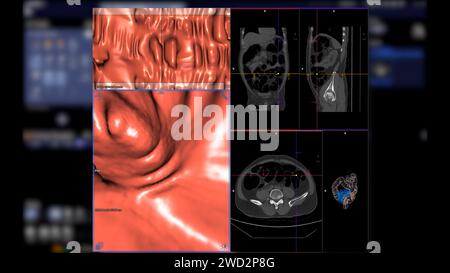 CT colonography , This imaging technique is often employed for colorectal cancer screening, providing detailed images of the colon's interior 3D rende Stock Photo