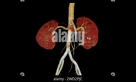 CTA Renal artery 3D is a medical imaging procedure using CT scans to examine the renal arteries It provides detailed images of the blood vessels suppl Stock Photo