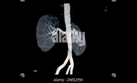 CTA Renal artery 3D is a medical imaging procedure using CT scans to examine the renal arteries It provides detailed images of the blood vessels suppl Stock Photo