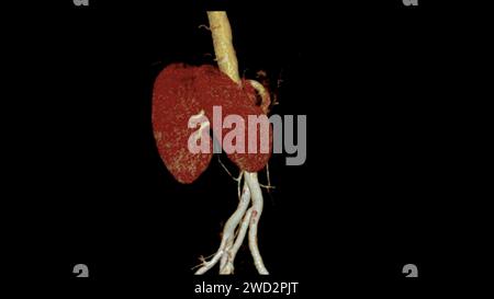 CTA Renal artery 3D is a medical imaging procedure using CT scans to examine the renal arteries It provides detailed images of the blood vessels suppl Stock Photo