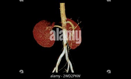 CTA Renal artery 3D is a medical imaging procedure using CT scans to examine the renal arteries It provides detailed images of the blood vessels suppl Stock Photo