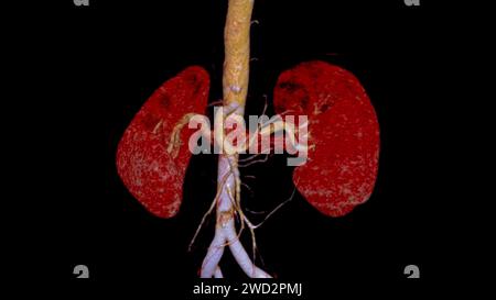 CTA Renal artery 3D is a medical imaging procedure using CT scans to examine the renal arteries It provides detailed images of the blood vessels suppl Stock Photo