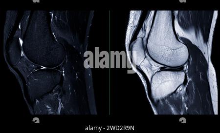 Magnetic resonance imaging or MRI knee comparison sagittal PDW and TIW ...