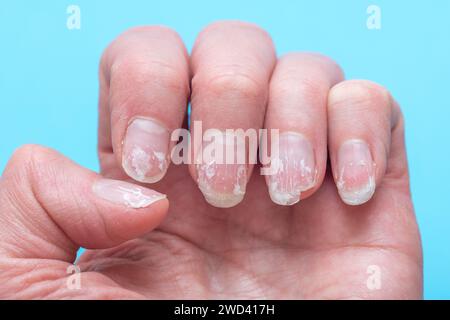 Flaky bitten and brittle nails without a manicure. Regrown nail cuticle and damaged nail plate after gel polish on blue background. Stock Photo