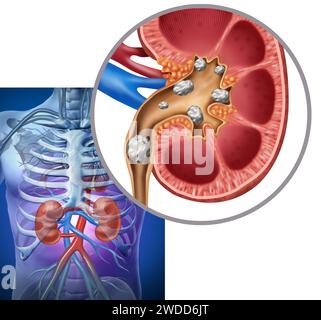 Nephrolithiasis or renal calculi as Kidney stone deposits medical concept as a Urinary tract obstruction with painful crystaline minerals and salts Stock Photo