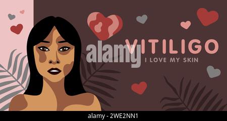 Banner about vitilingo skin disease with young beautiful woman of Asian appearance, minimalistic vector illustration, text I love my skin Stock Vector
