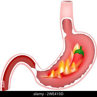Heartburn of stomach. Cross section of stomach with hot flames and red chili pepper. Pyrosis, cardialgia or acid indigestion. burning sensation in the Stock Vector