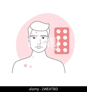 Medical treatment of puberty acne for sad man with pimples on face vector illustration Stock Vector