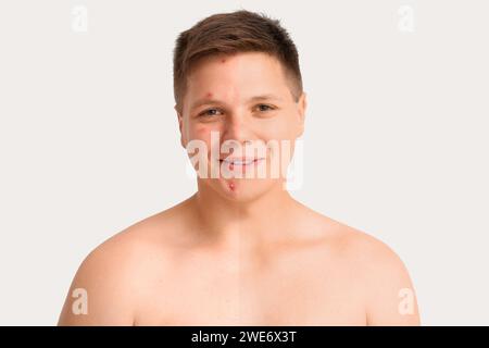 Comparison portrait of teenage boy before and after acne treatment on ...