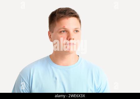 Comparison portrait of teenage boy before and after acne treatment on ...