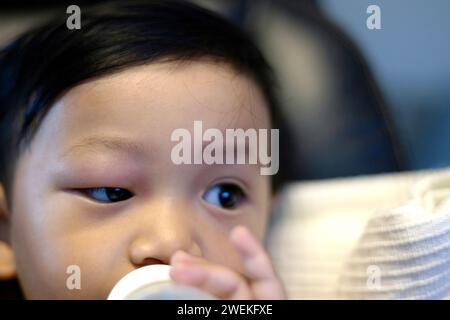 Face of boy with a swollen eye from an insect bite. closeup view. Allergy to insect bites. Stock Photo