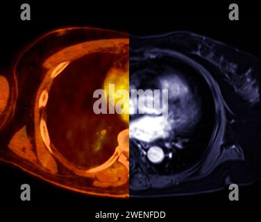 CT scan of Chest Axial view in color mode  for diagnostic Pulmonary embolism (PE) , lung cancer and covid-19. Stock Photo