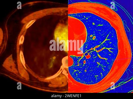 CT scan of Chest Axial view in color mode  for diagnostic Pulmonary embolism (PE) , lung cancer and covid-19. Stock Photo