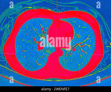 CT scan of Chest Axial view in color mode  for diagnostic Pulmonary embolism (PE) , lung cancer and covid-19. Stock Photo