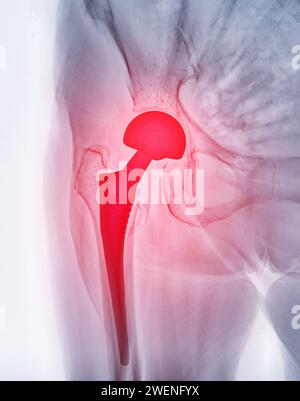 An X-ray reveals both hip joints with TOTAL HIP ARTHROPLASTY, showcasing the success of the surgical procedure and providing a visual testament to the Stock Photo