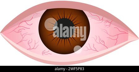 Dry eye syndrome. Inflamed bloodshot eyeball with swelling, irritation and red conjunctiva. Symptoms of infection, allergy, keratitis, blepharitis, conjunctivitis, uveitis. Vector cartoon illustration Stock Vector