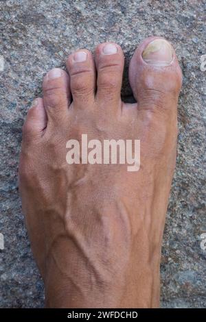 Toenails with fungus problems,Onychomycosis, also known as tinea