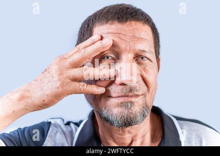 Elderly person with irritated eyes. Senior man with eye pain isolated. Old man with conjunctivitis on white background Stock Photo