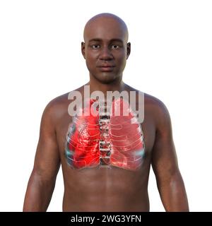 Man with lungs affected by pneumonia, illustration Stock Photo