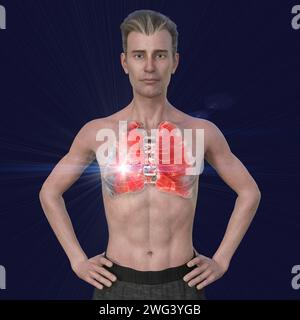 Man with lungs affected by pneumonia, illustration Stock Photo