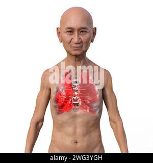 Man with lungs affected by pneumonia, illustration Stock Photo